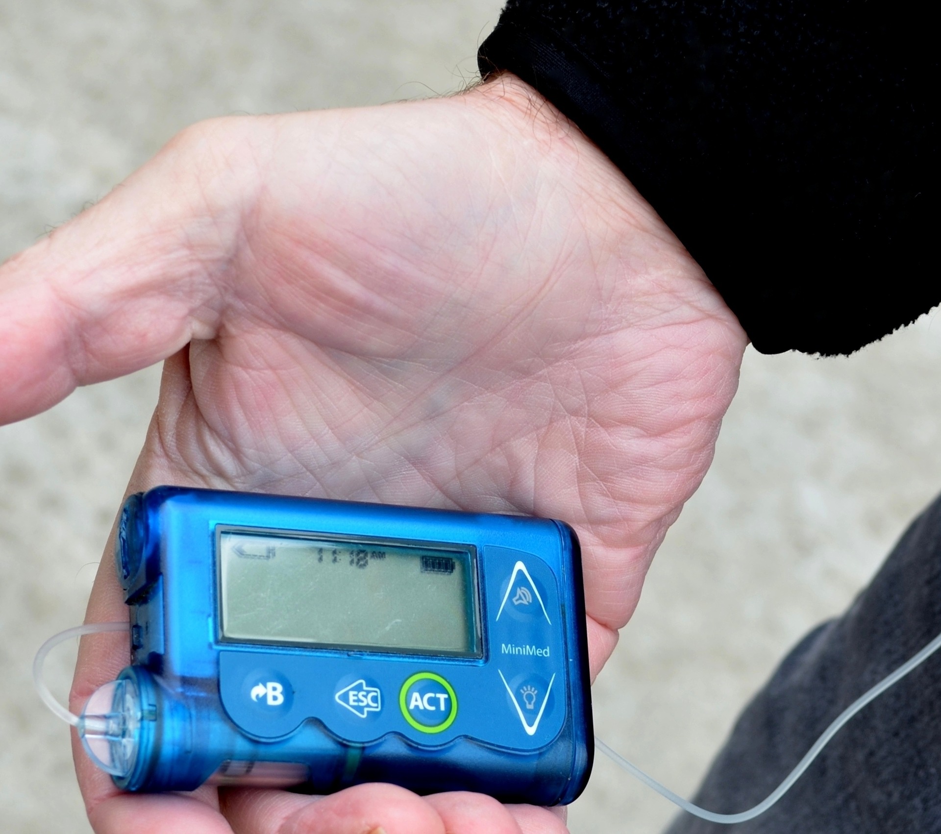 HALMED poziva na zamjenu MiniMed inzulinskih pumpa serije 600 s prozirnim prstenom za učvršćivanje