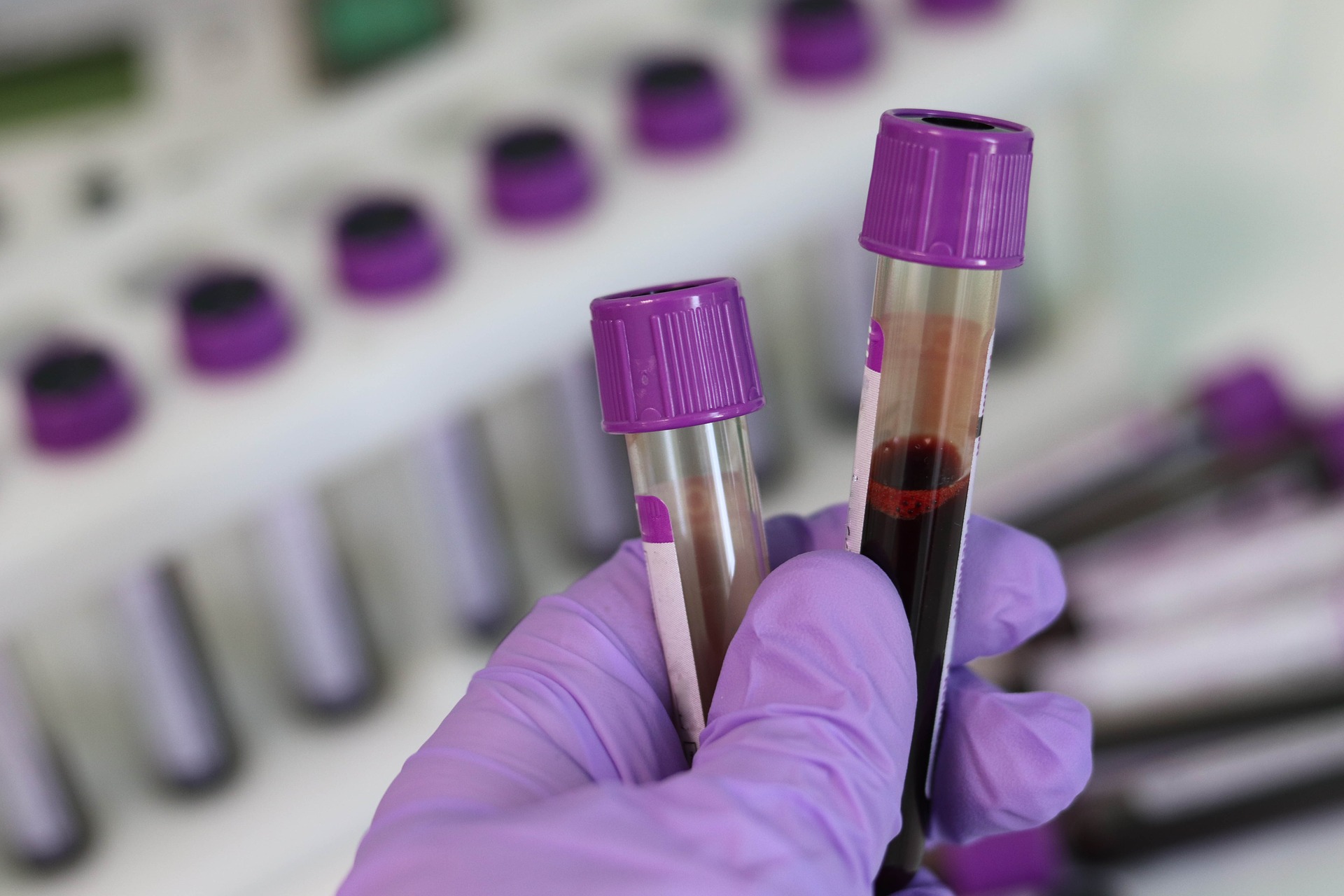 Znanstvenici otkrili pomoću kojeg biomarkera u krvi se može predvidjeti prijeti li COVID pacijentu smrt