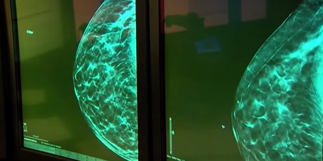 Umjetna inteligencija uočila rak dojke koji je promaknuo liječnicima